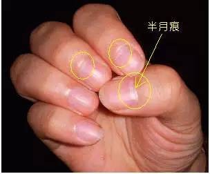 指甲上的半月痕与健康封面